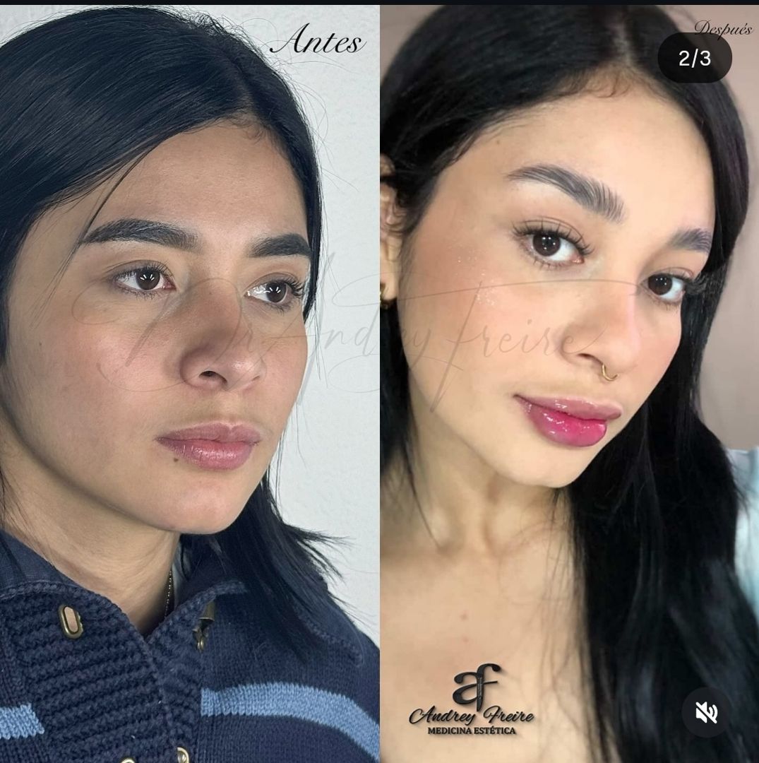 Aumento de labios antes y después
