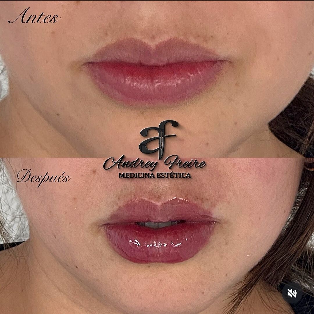 Aumento de labios antes y después