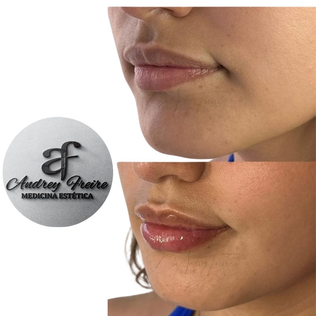 Aumento de labios en Quito
