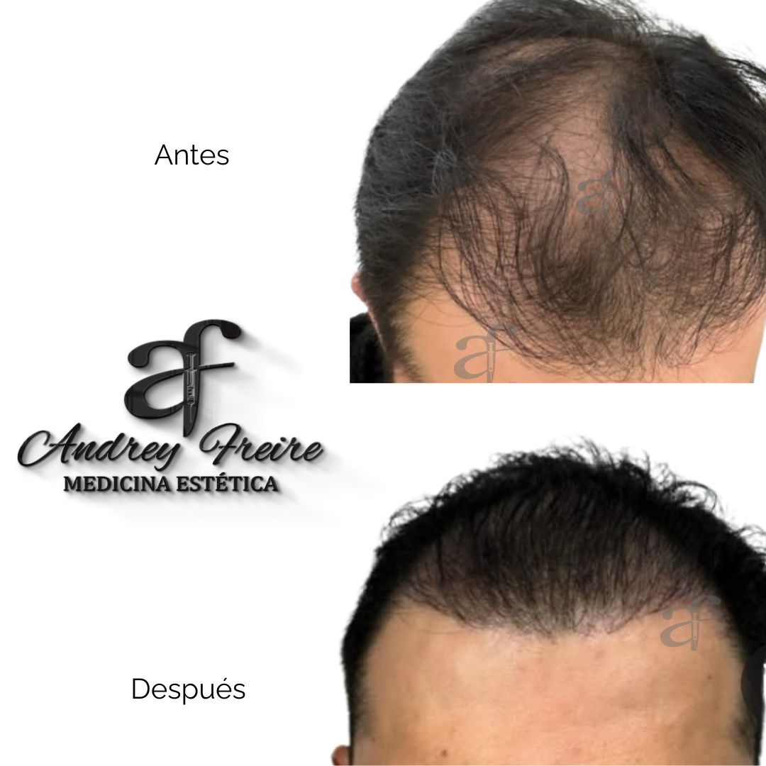 Implante capilar antes y después