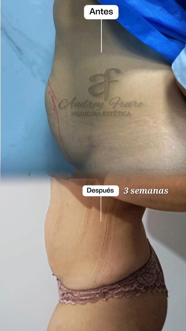 Mini Lipo Trioss Láser: abdomen · a las 3 semanas, con faja de compresión