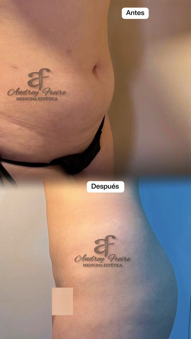 Mini Lipo Trioss Láser: abdomen y flanco · perfil antes y después